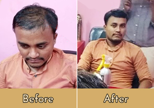 Hair Pasting in Kolkata